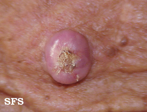 File:Keratoacanthoma (Dermatology Atlas 8).jpg