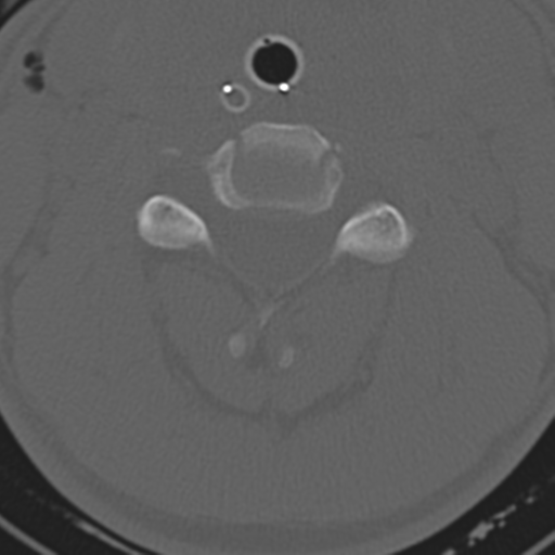 File:Multitrauma with diffuse axonal injury, temporal bone fractures and traumatic caroticocavernous fistula (Radiopaedia 37242-39035 Axial 185).png
