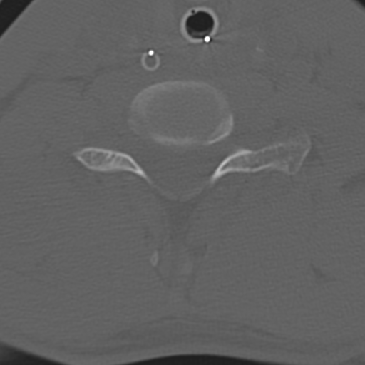 File:Multitrauma with diffuse axonal injury, temporal bone fractures and traumatic caroticocavernous fistula (Radiopaedia 37242-39035 Axial 186).png