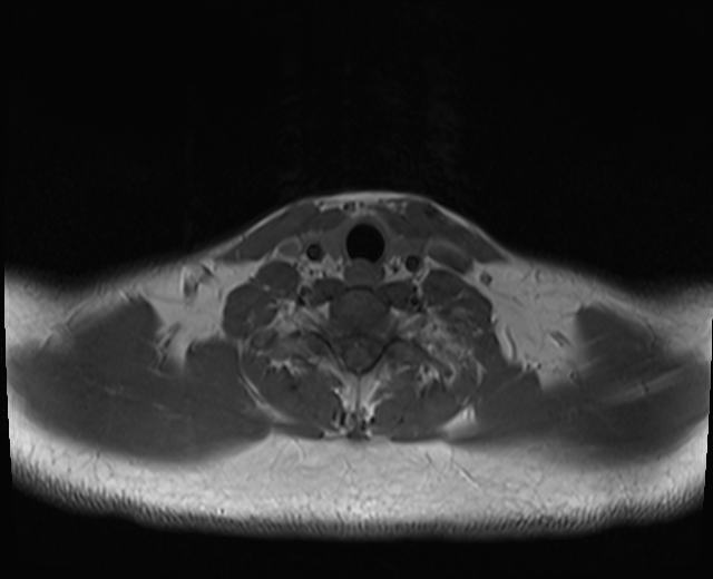 File:Nasopharyngeal carcinoma with perineural spread (Radiopaedia 55030-61380 Axial T1 5).jpg
