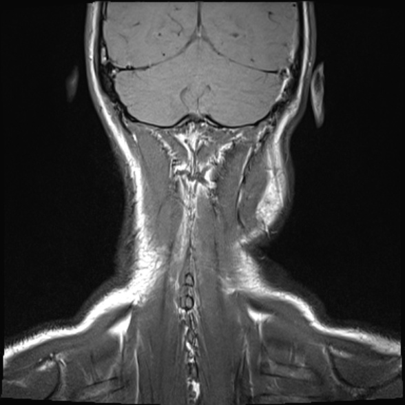 Nasopharyngeal carcinoma with skull base invasion (Radiopaedia 53415-59485 Coronal T1 1).jpg