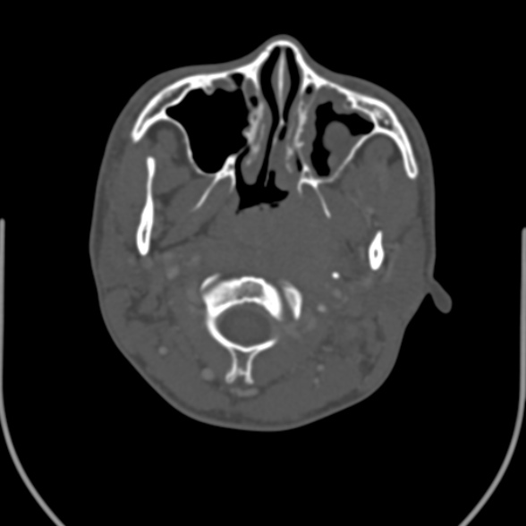Nasopharyngeal carcinoma with skull base invasion (Radiopaedia 53415-59705 Axial bone window 56).jpg