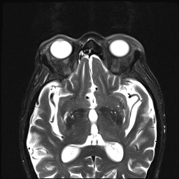 File:Nasopharyngeal carcinoma with skull base invasion (Radiopaedia 59258-66600 D 2).jpg