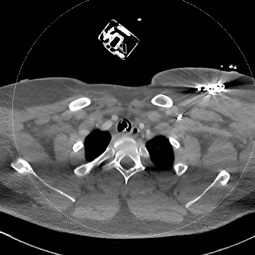 File:Neck CT angiogram (intraosseous vascular access) (Radiopaedia 55481-61945 B 96).jpg
