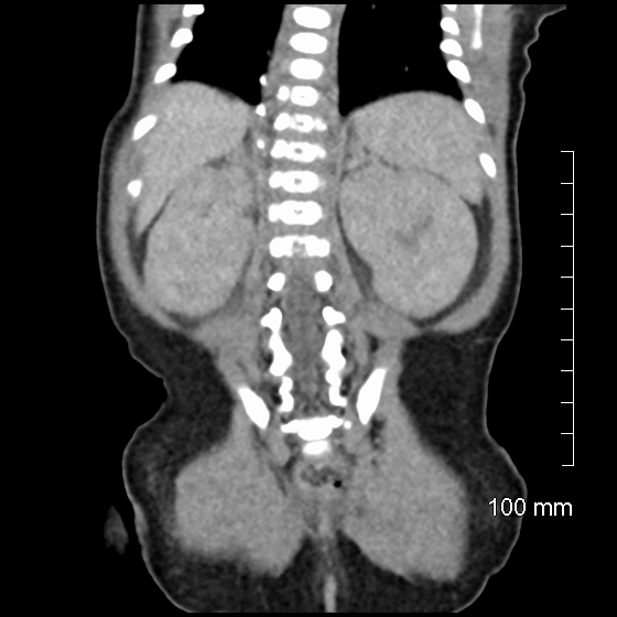 File:Neonatal neuroblastoma (Radiopaedia 56651-63438 Coronal non-contrast 39).jpg