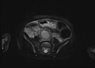Neonatal prostatic utricle abscess - cyst (Radiopaedia 69511-79394 Axial T2 fat sat 32).jpg