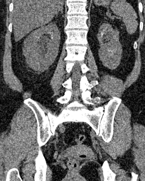 File:Nephrostomy for urosepsis (Radiopaedia 26180-26330 non-contrast 62).jpg