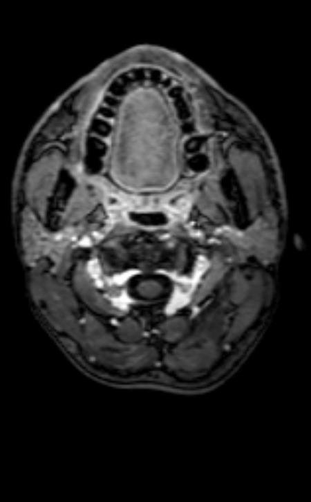 Neuro-Behçet disease (Radiopaedia 90112-107294 Axial T1 C+ 217).jpg