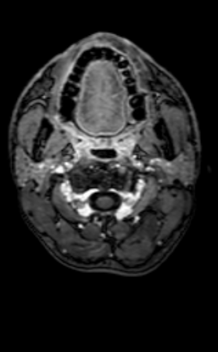 Neuro-Behçet disease (Radiopaedia 90112-107294 Axial T1 C+ 218).jpg