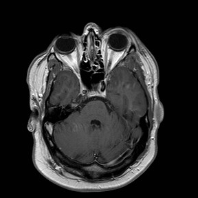 File:Neuro-Behcet's disease (Radiopaedia 21557-21506 Axial T1 C+ 9).jpg
