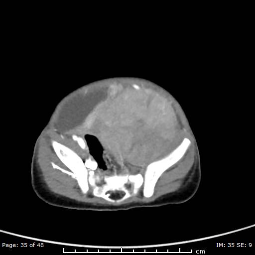 File:Neuroblastoma (Radiopaedia 41472-44355 A 35).jpg