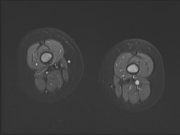File:Neuroblastoma with bone metastases (Radiopaedia 67080-76414 Axial STIR 20).jpg