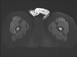 File:Neuroblastoma with bone metastases (Radiopaedia 67080-76414 Axial STIR 36).jpg