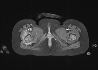 File:Neuroblastoma with bone metastases (Radiopaedia 67080-76414 Axial T1 C+ fat sat 41).jpg
