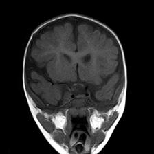 File:Neurofibromatosis type 1 (Radiopaedia 30089-30671 Coronal T1 11).jpg