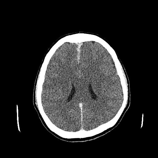 File:Neurofibromatosis type 2 (Radiopaedia 25389-25637 Axial C+ 61).jpg