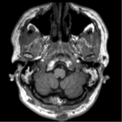 File:Neurofibromatosis type 2 (Radiopaedia 44936-48838 Axial T1 12).png