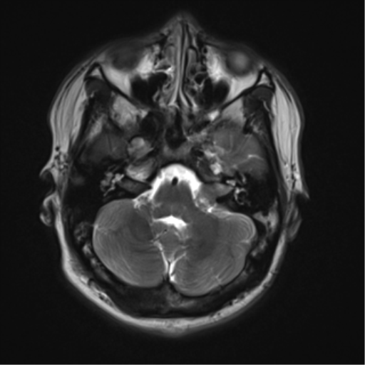File:Neurofibromatosis type 2 (Radiopaedia 44936-48838 Axial T2 5).png