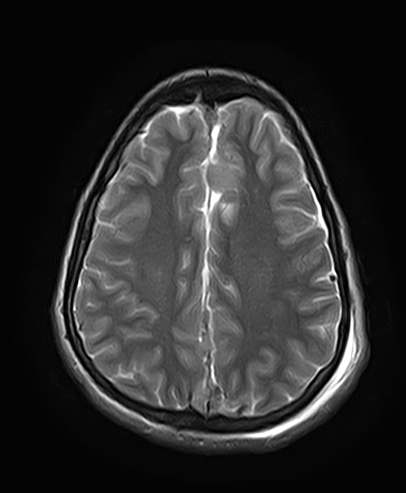 File:Neurofibromatosis type 2 (Radiopaedia 66211-75401 Axial T2 21).jpg