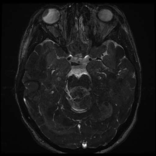 Neurofibromatosis type 2 - bilateral acoustic neuromata (Radiopaedia 40060-42566 Axial FIESTA 79).png