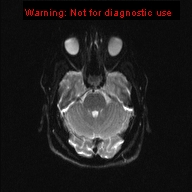 File:Neuroglial cyst (Radiopaedia 10713-11184 Axial DWI 16).jpg