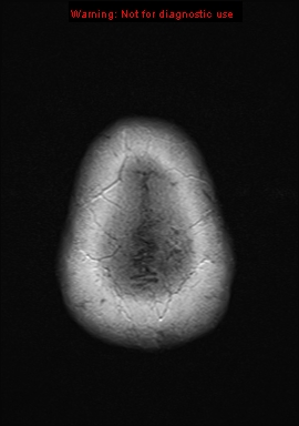 File:Neuroglial cyst (Radiopaedia 10713-11184 Axial T1 C+ 1).jpg