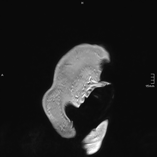 Neurosarcoidosis - involvement of the mesial temporal lobes (Radiopaedia 67429-76820 Sagittal T1 C+ 3).jpg