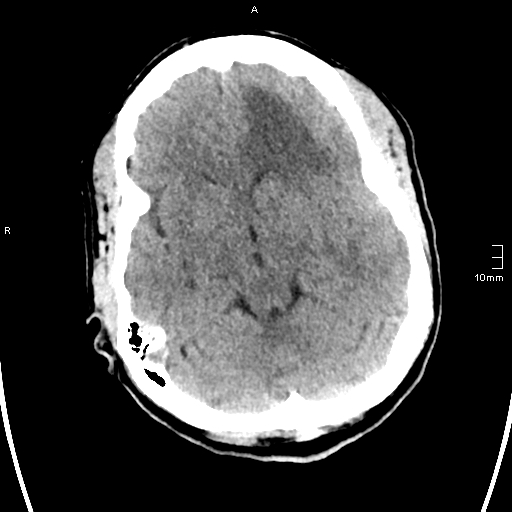 File:Neurotoxoplasmosis - concentric target sign (Radiopaedia 70644-80783 Axial non-contrast 13).jpg