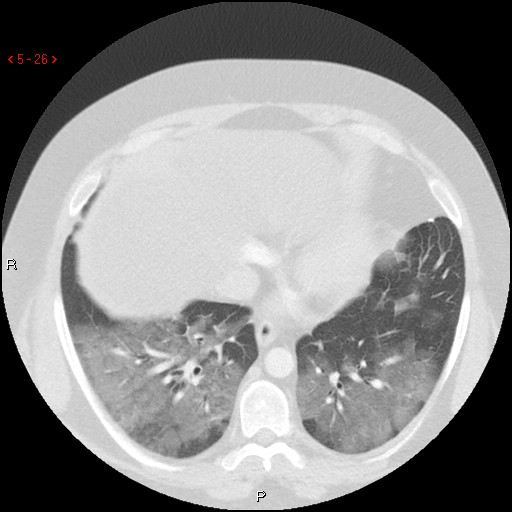 File:Non-specific interstitial pneumonitis (Radiopaedia 27044-27222 Axial lung window 17).jpg
