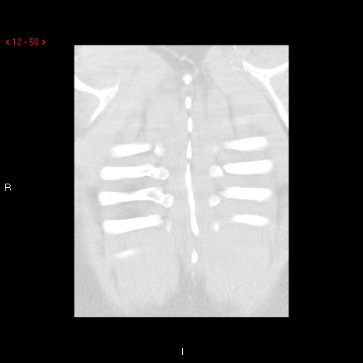 File:Non-specific interstitial pneumonitis (Radiopaedia 27044-27222 Coronal lung window 50).jpg