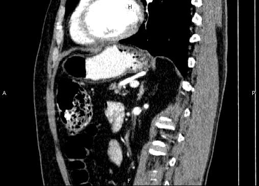 Non-syndromic pancreatic endocrine tumor (Radiopaedia 86958-103178 E 65).jpg