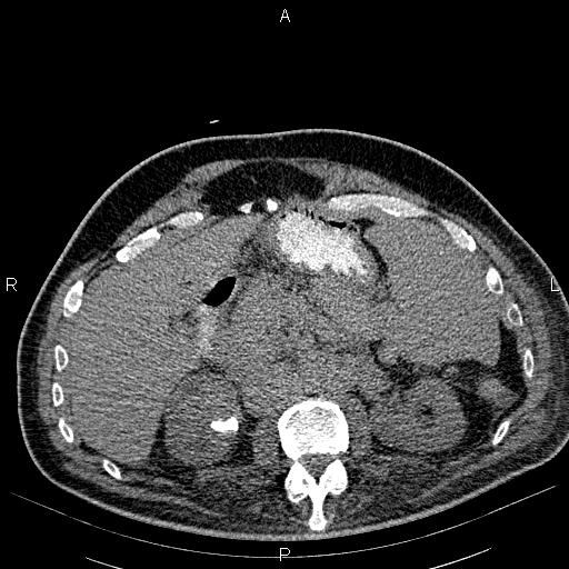 File:Non Hodgkin lymphoma in a patient with ankylosing spondylitis (Radiopaedia 84323-99621 Axial non-contrast 33).jpg