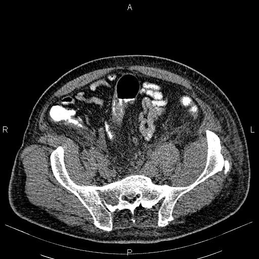 File:Non Hodgkin lymphoma in a patient with ankylosing spondylitis (Radiopaedia 84323-99621 Axial non-contrast 50).jpg