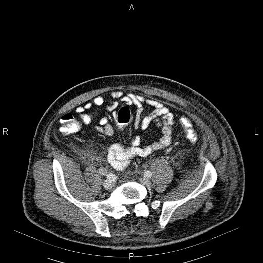 File:Non Hodgkin lymphoma in a patient with ankylosing spondylitis (Radiopaedia 84323-99621 B 51).jpg
