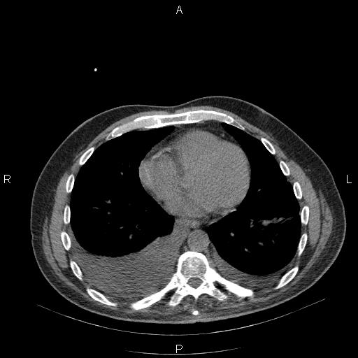 File:Non Hodgkin lymphoma in a patient with ankylosing spondylitis (Radiopaedia 84323-99624 Axial non-contrast 23).jpg