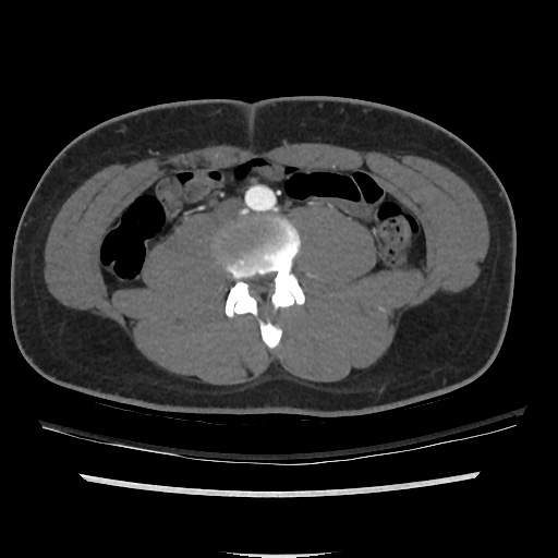 File:Normal CT angiogram of pelvis (Radiopaedia 45390-49430 A 12).jpg