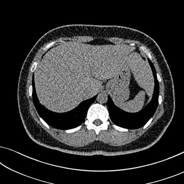 Normal CT chest- adult female (Radiopaedia 52522-58428 Axial non-contrast 115).jpg