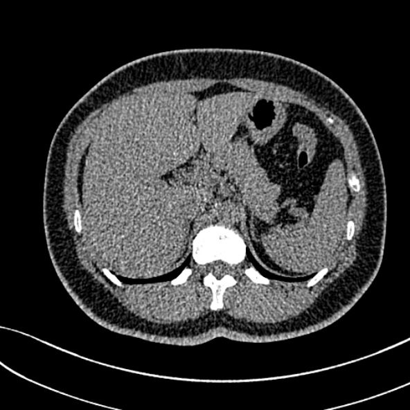 Normal CT chest- adult female (Radiopaedia 52522-58428 Axial non-contrast 131).jpg