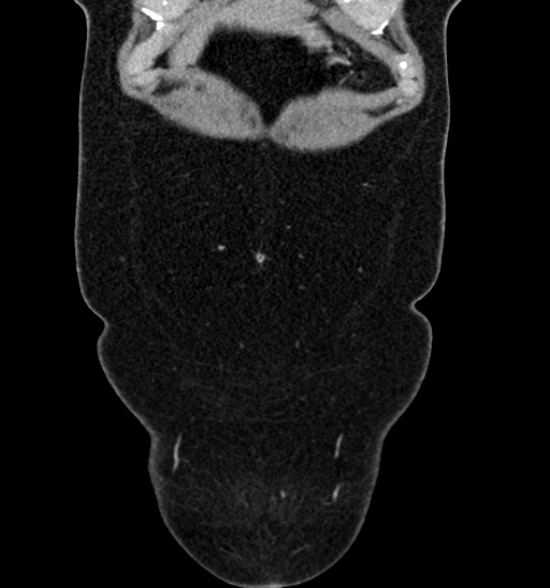 File:Normal CT intravenous urogram (Radiopaedia 39444-41759 A 162).jpg