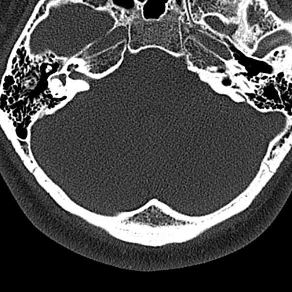 Normal CT of the cervical spine (Radiopaedia 53322-59305 Axial bone window 7).jpg