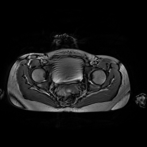 File:Normal MRI abdomen in pregnancy (Radiopaedia 88001-104541 Axial Gradient Echo 52).jpg