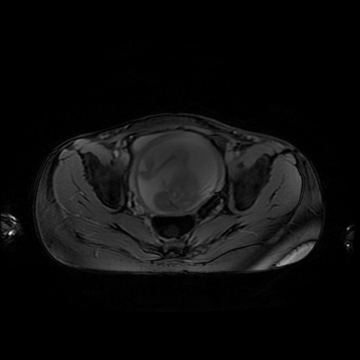 File:Normal MRI abdomen in pregnancy (Radiopaedia 88001-104541 D 48).jpg