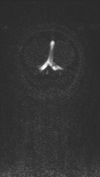 Normal MRI brain with MRV- teenager (Radiopaedia 49425-54553 Coronal MRV 215).jpg