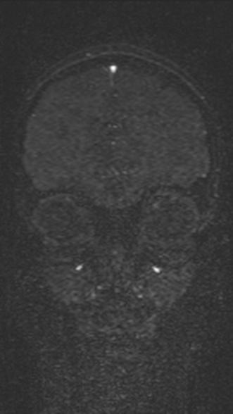 Normal MRI brain with MRV- teenager (Radiopaedia 49425-54553 Coronal MRV 64).jpg