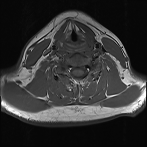 File:Normal MRI cervical spine (infection protocol) (Radiopaedia 53916-60039 Axial 32).png