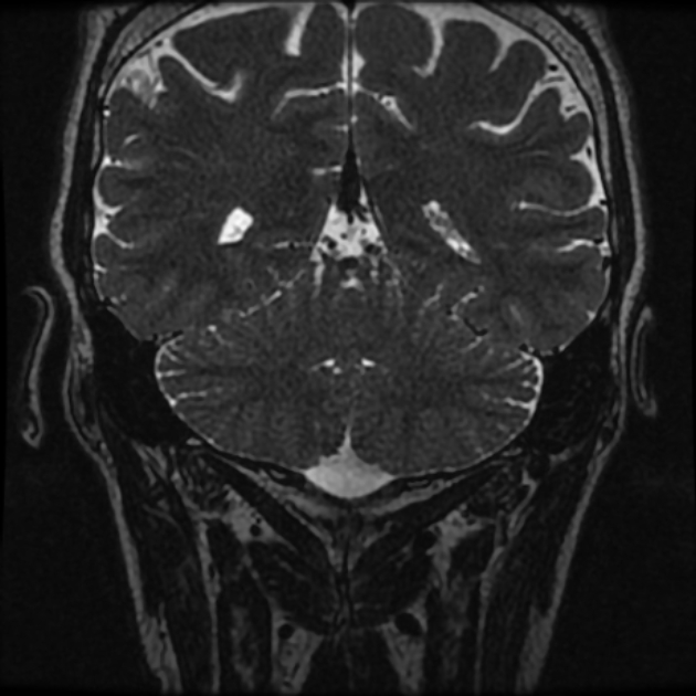 Normal MRI petrous (Radiopaedia 91317-108949 Coronal T2 102).jpg