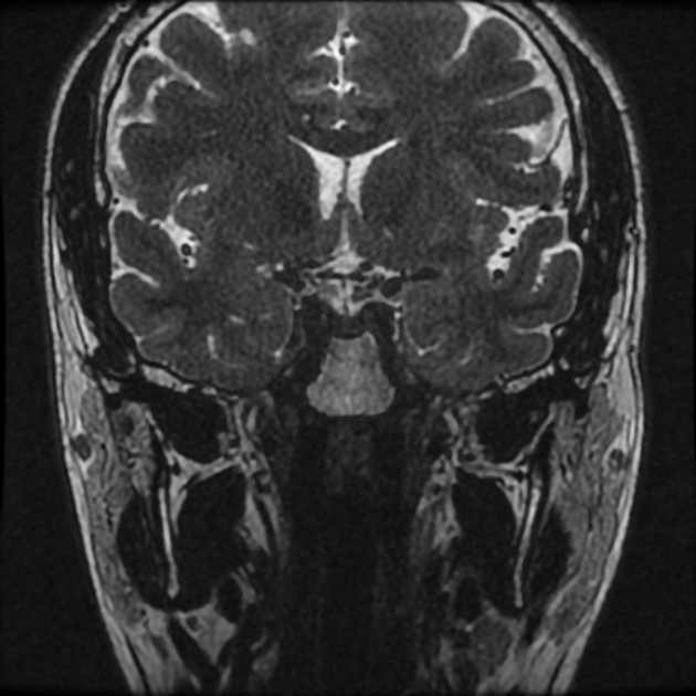 Normal MRI petrous (Radiopaedia 91317-108949 Coronal T2 2).jpg
