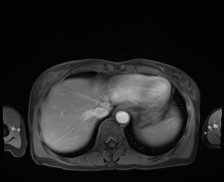 Normal adrenal glands MRI (Radiopaedia 82017-96004 M 12).jpg