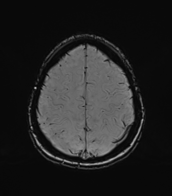 Normal brain MRI (TLE protocol) (Radiopaedia 40748-43405 Axial SWI 71).png