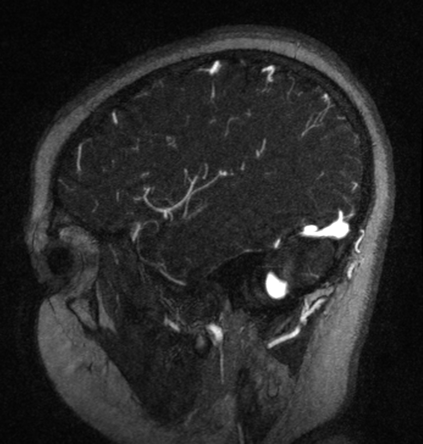 Normal brain MRI and venogram (Radiopaedia 39554-41862 Sagittal MRV 13).jpg